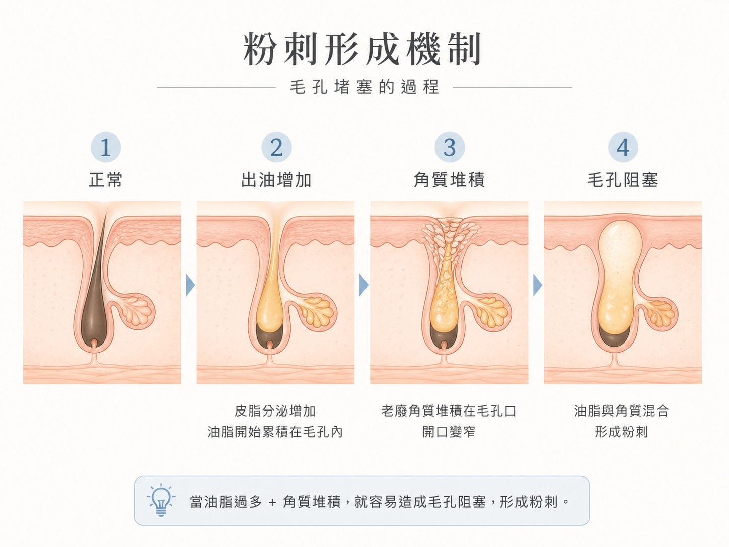 粉刺形成原因示意圖